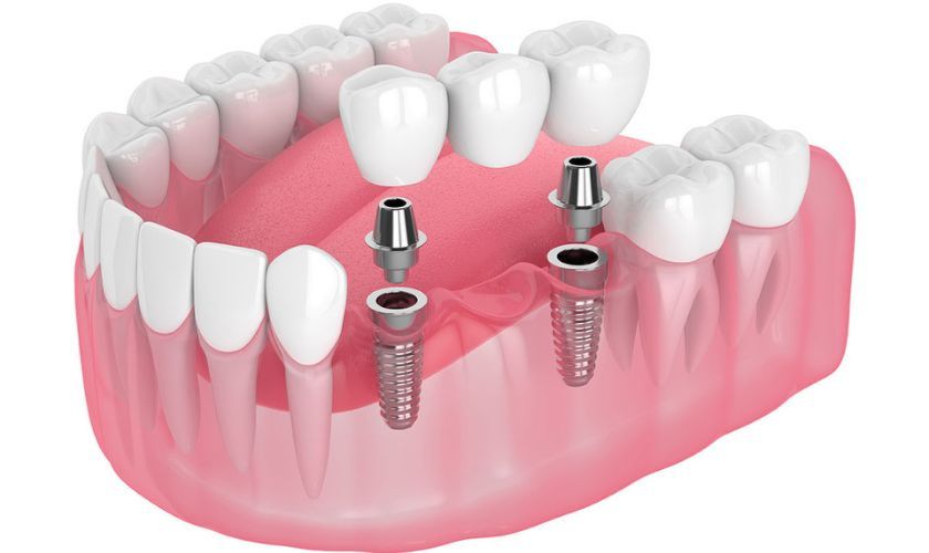 Dental-implants