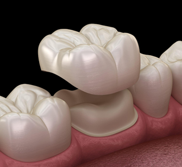 Dental crowns placed on tooth models showing ceramic restorations on gum tissue base.