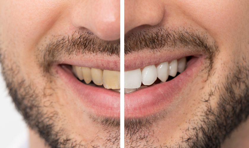 Teeth Whitening - Covaney
