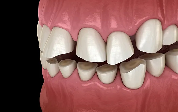 3D dental model showing misaligned upper and lower teeth with gaps and spacing issues.