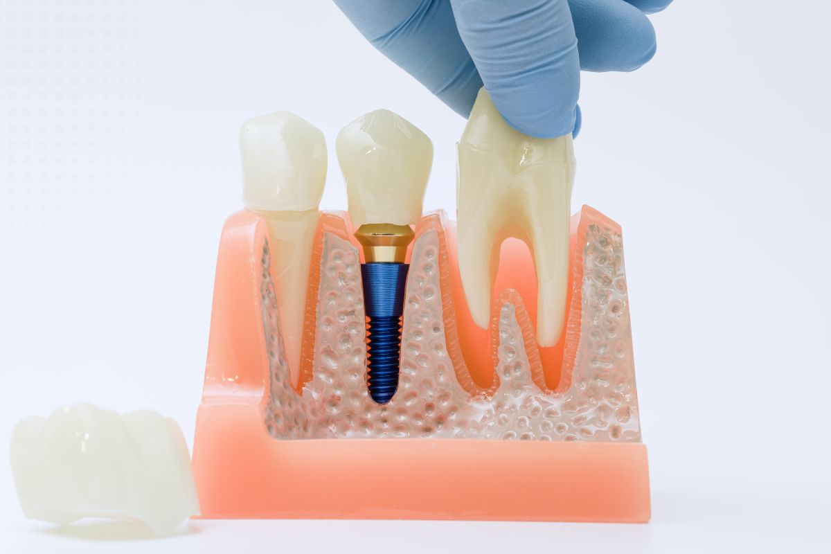 what-young-adults-need-to-know-about-dental-implants