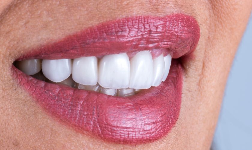 Porcelain Crowns