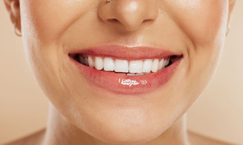 Veneers