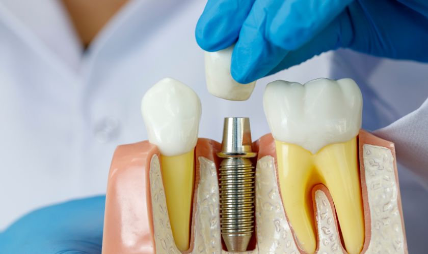 dental implants newport news