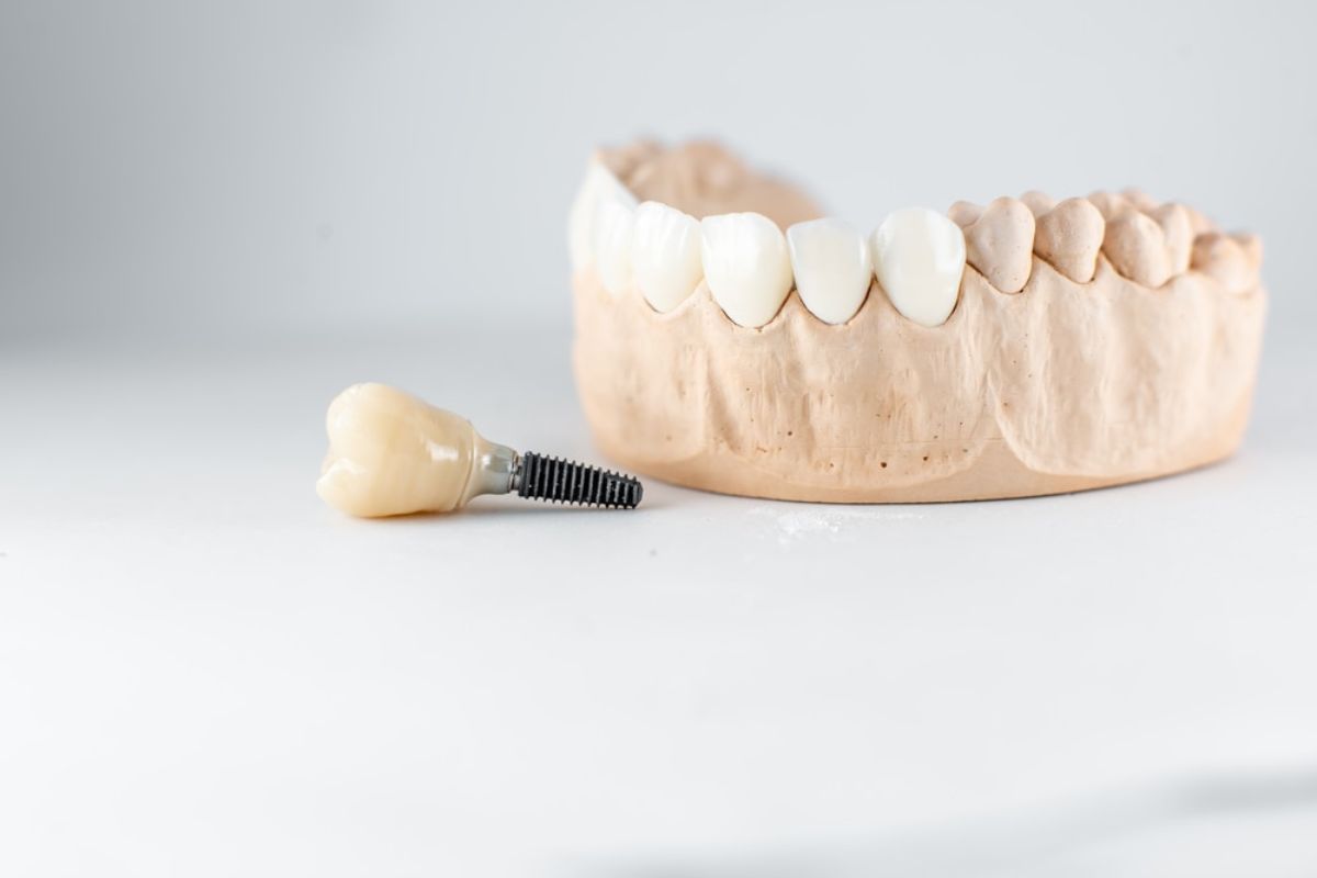 Dental Implants in Newport News