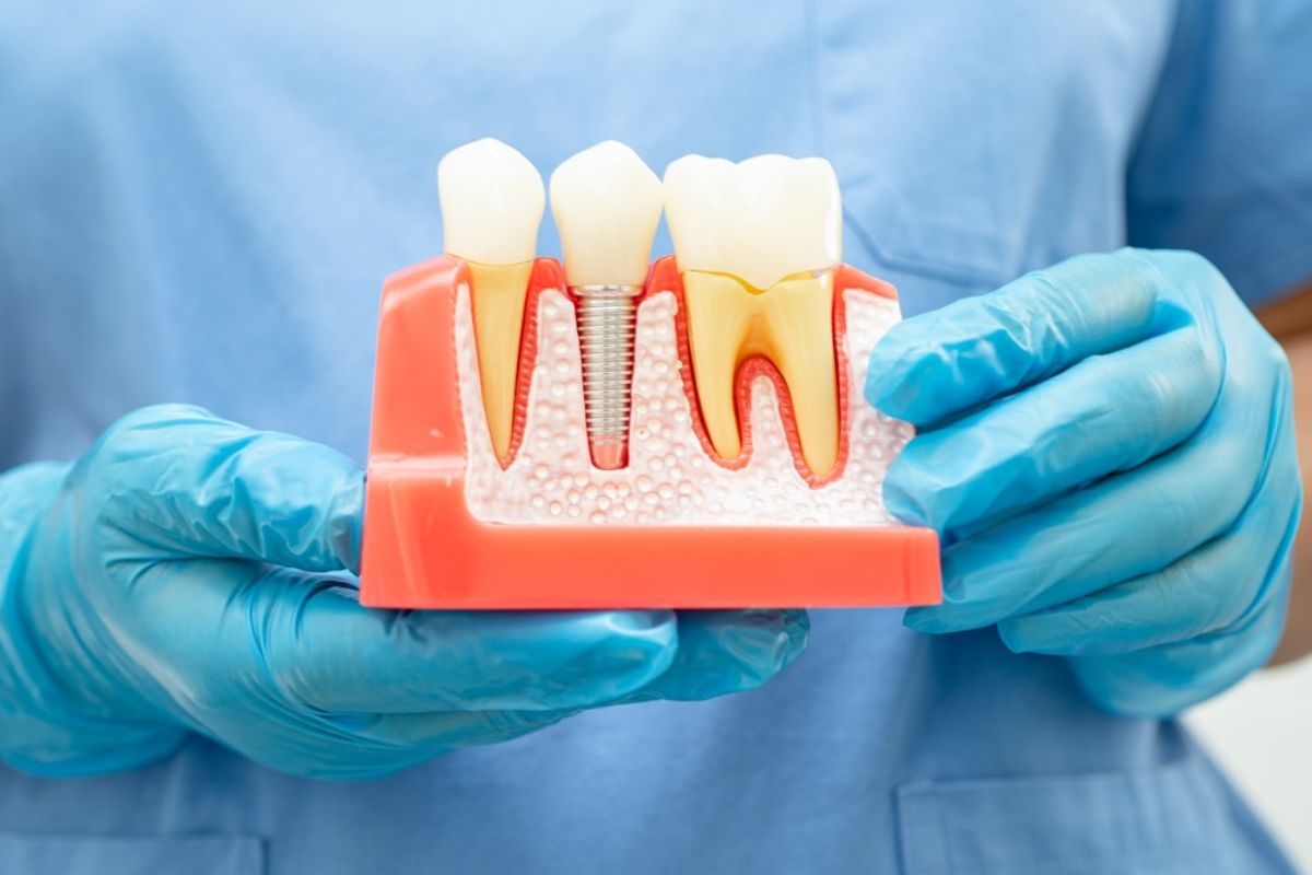 dental-implants