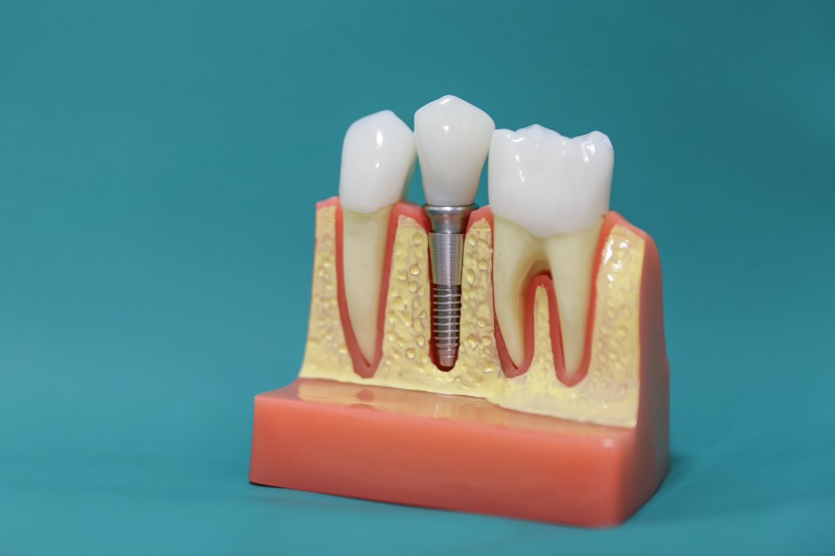 Can You Eat Rice After Dental Implant Surgery