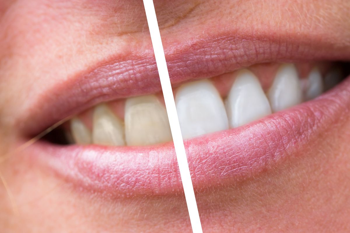 Before and after comparison of tooth whitening results on a smiling mouth.