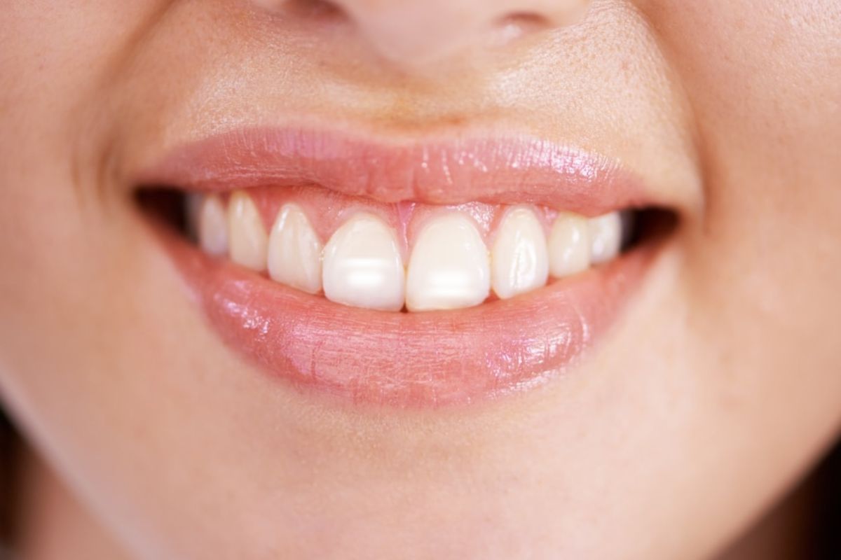 White Spots on Teeth