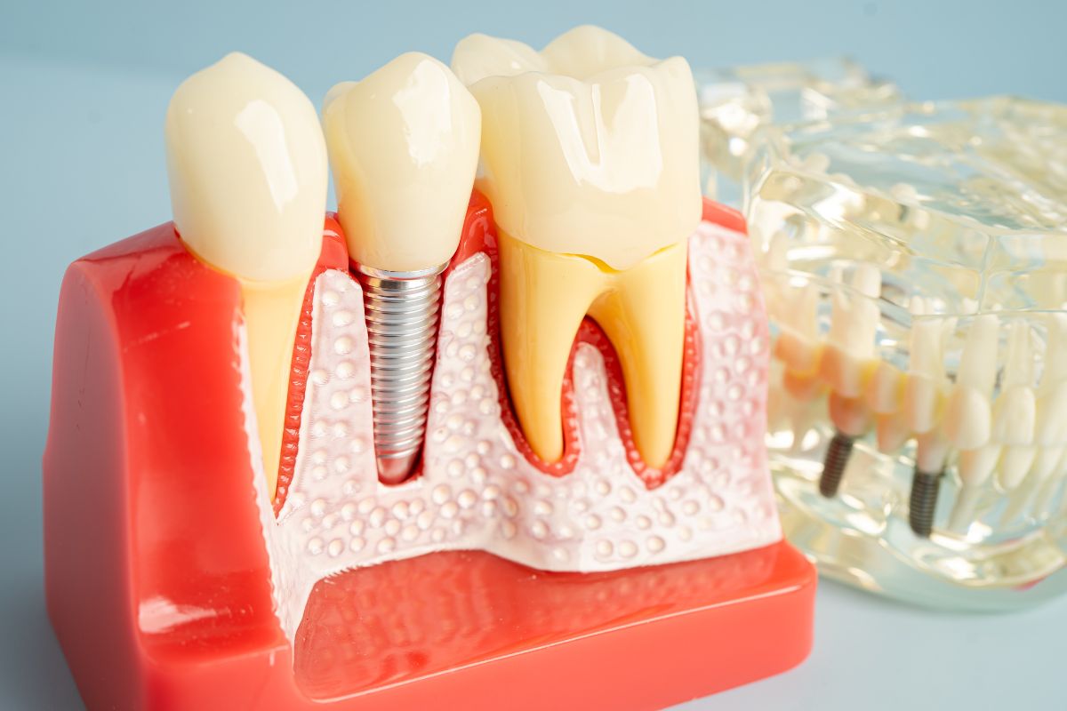 Do Dental Implants Hurt