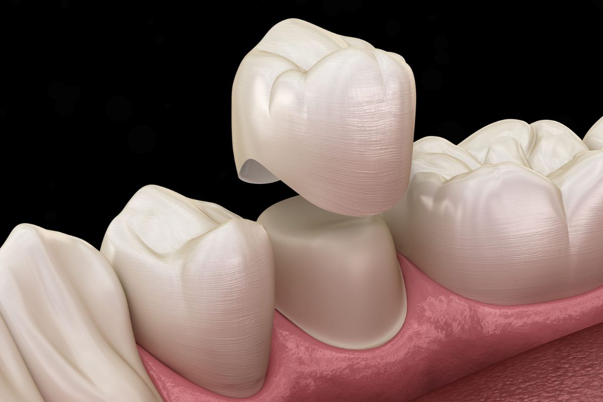 Does Getting a Crown Hurt Newport News