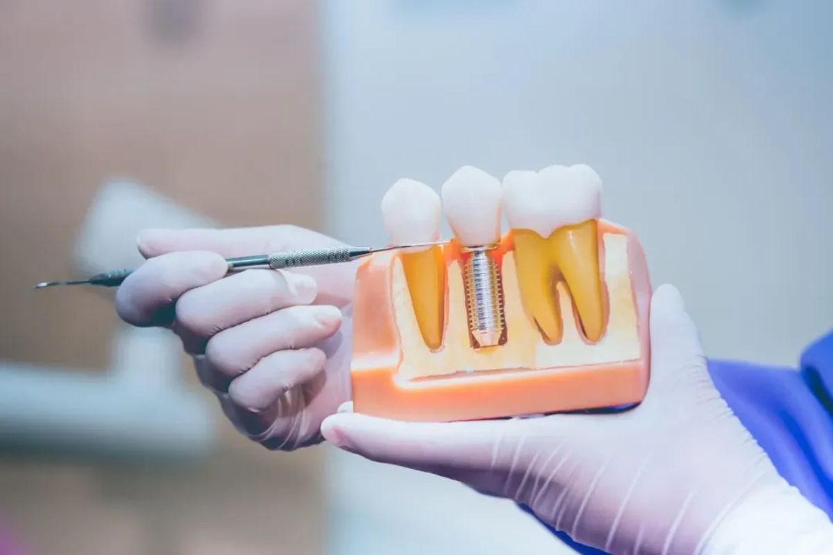 how long does it take to get dental implants