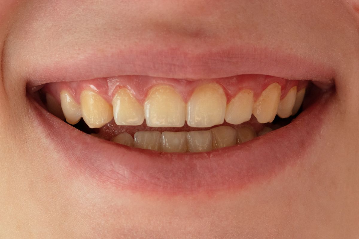Tooth Discoloration