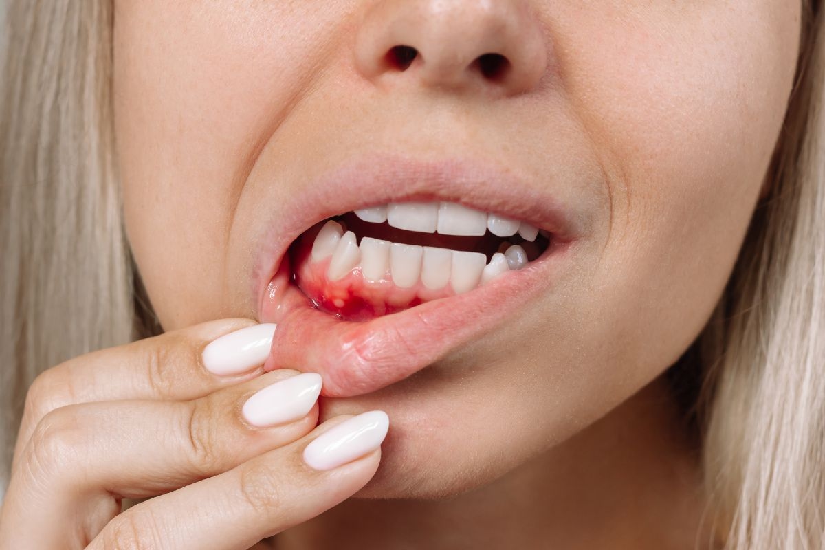 bleeding-gums-newport-news